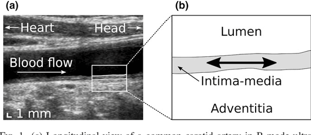 Figure 1 for Dynamic Block Matching to assess the longitudinal component of the dense motion field of the carotid artery wall in B-mode ultrasound sequences - Association with coronary artery disease
