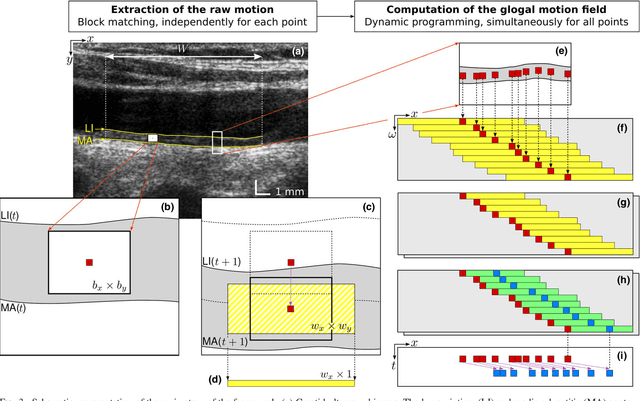 Figure 2 for Dynamic Block Matching to assess the longitudinal component of the dense motion field of the carotid artery wall in B-mode ultrasound sequences - Association with coronary artery disease