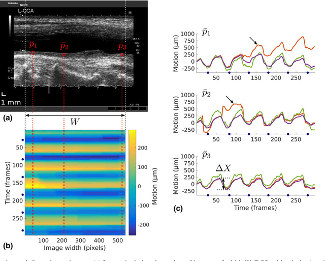 Figure 4 for Dynamic Block Matching to assess the longitudinal component of the dense motion field of the carotid artery wall in B-mode ultrasound sequences - Association with coronary artery disease