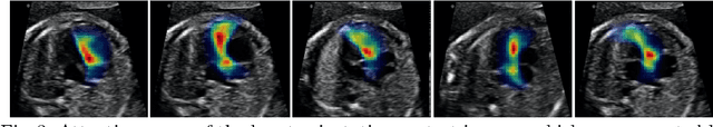 Figure 3 for Temporal HeartNet: Towards Human-Level Automatic Analysis of Fetal Cardiac Screening Video