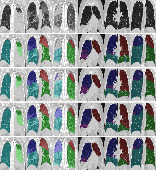 Figure 4 for Contextual Two-Stage U-Nets for Robust Pulmonary Lobe Segmentation in CT Scans of COVID-19 and COPD Patients