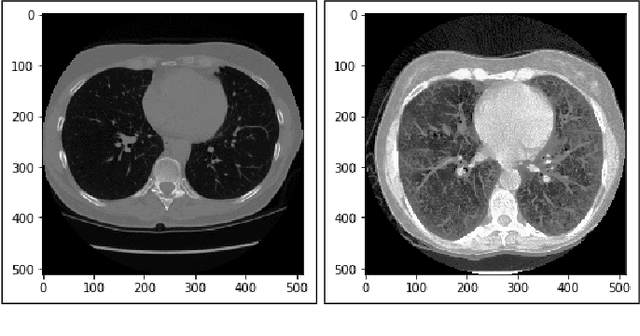 Figure 2 for Lung Cancer Detection and Classification based on Image Processing and Statistical Learning
