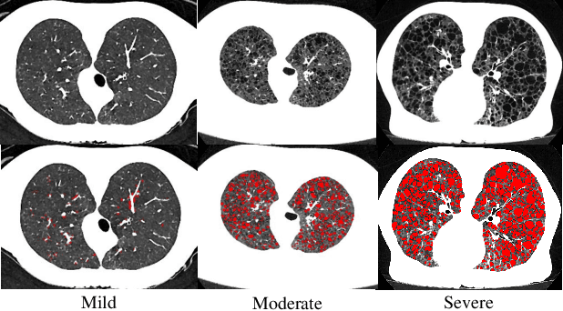 Figure 1 for Self-Learning to Detect and Segment Cysts in Lung CT Images without Manual Annotation