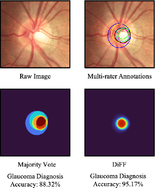Figure 1 for Calibrate the inter-observer segmentation uncertainty via diagnosis-first principle