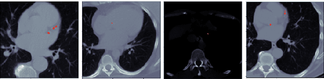 Figure 3 for Automated Coronary Calcium Scoring using U-Net Models through Semi-supervised Learning on Non-Gated CT Scans