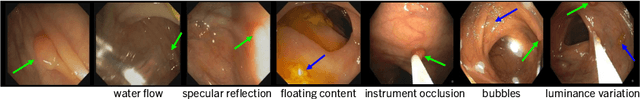 Figure 1 for Multi-frame Collaboration for Effective Endoscopic Video Polyp Detection via Spatial-Temporal Feature Transformation
