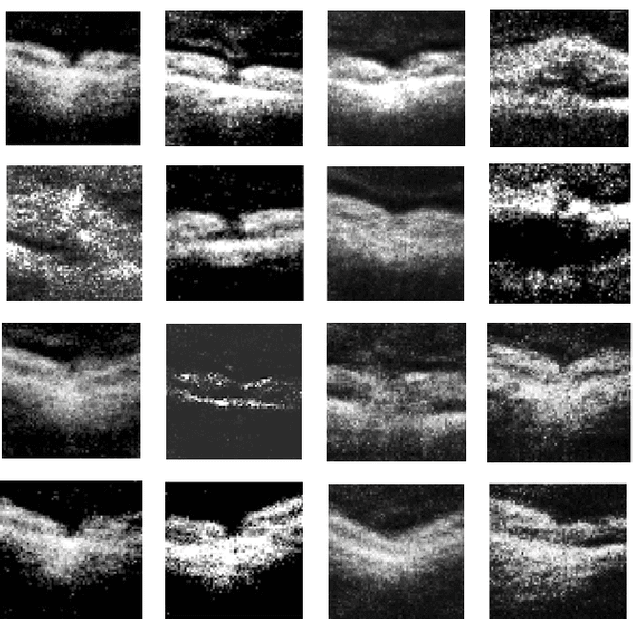 Figure 1 for Generative Adversarial Networks Synthesize Realistic OCT Images of the Retina