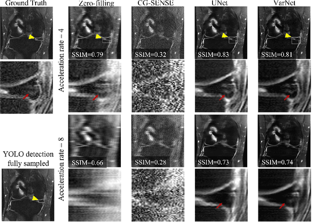 Figure 3 for End-to-End AI-based MRI Reconstruction and Lesion Detection Pipeline for Evaluation of Deep Learning Image Reconstruction