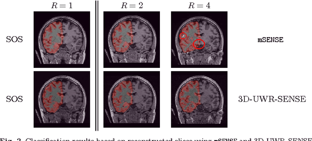 Figure 3 for Spatio-temporal wavelet regularization for parallel MRI reconstruction: application to functional MRI
