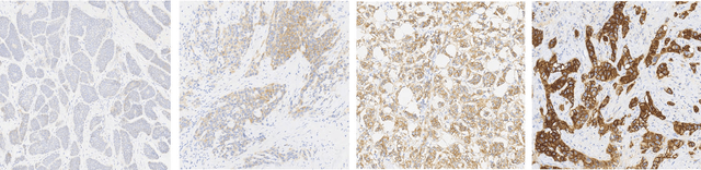 Figure 1 for Her2 Challenge Contest: A Detailed Assessment of Automated Her2 Scoring Algorithms in Whole Slide Images of Breast Cancer Tissues