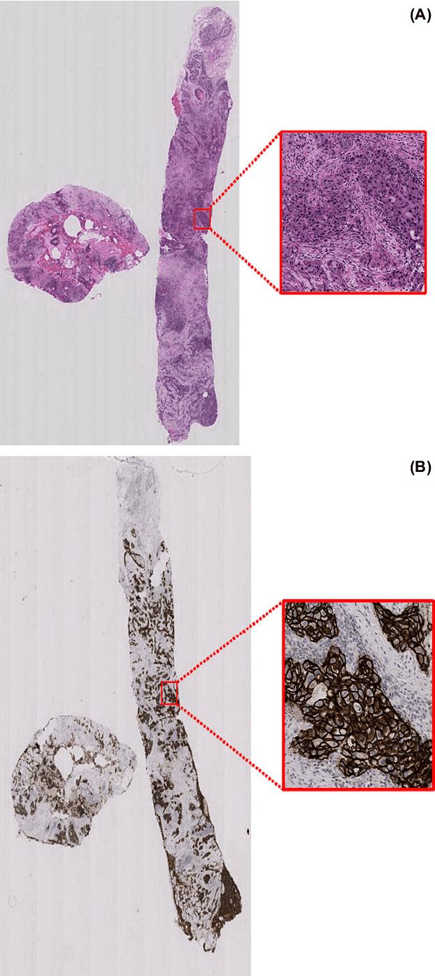 Figure 3 for Her2 Challenge Contest: A Detailed Assessment of Automated Her2 Scoring Algorithms in Whole Slide Images of Breast Cancer Tissues