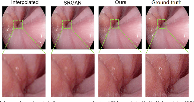 Figure 4 for EndoL2H: Deep Super-Resolution for Capsule Endoscopy