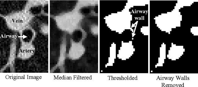 Figure 1 for Automated segmentation of the pulmonary arteries in low-dose CT by vessel tracking