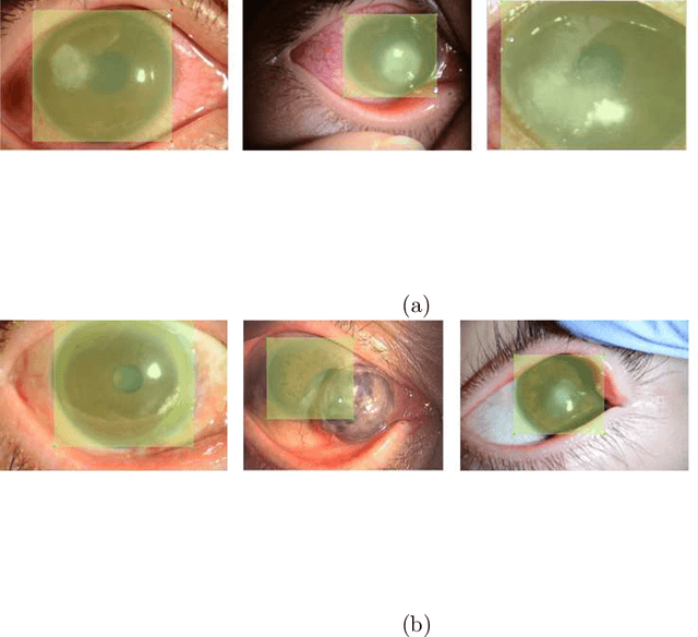 Figure 4 for Automated eye disease classification method from anterior eye image using anatomical structure focused image classification technique