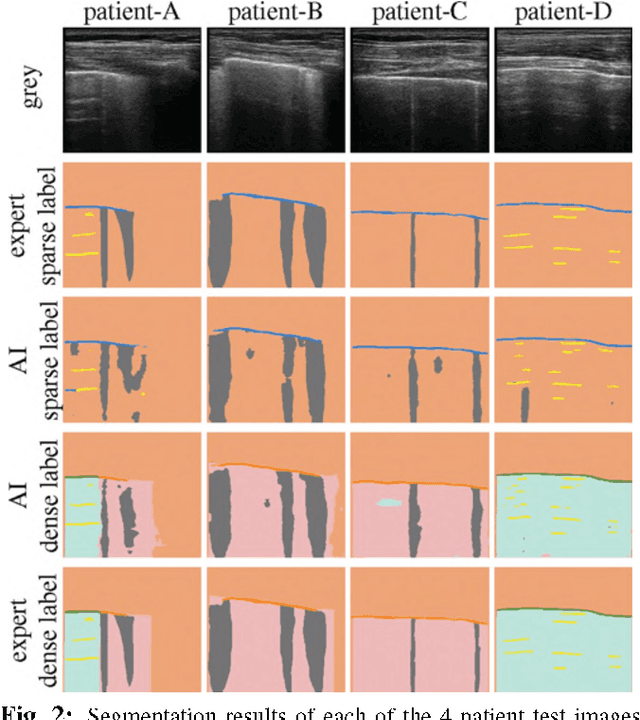 Figure 4 for Dense Pixel-Labeling for Reverse-Transfer and Diagnostic Learning on Lung Ultrasound for COVID-19 and Pneumonia Detection