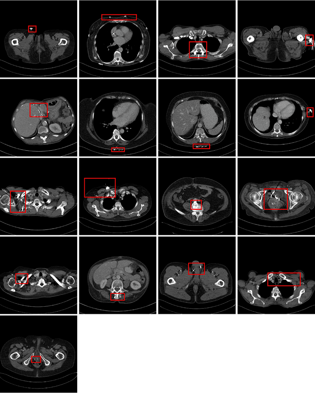 Figure 4 for Trainable Joint Bilateral Filters for Enhanced Prediction Stability in Low-dose CT