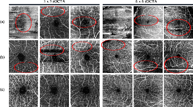 Figure 1 for A Deep Learning-based Quality Assessment and Segmentation System with a Large-scale Benchmark Dataset for Optical Coherence Tomographic Angiography Image