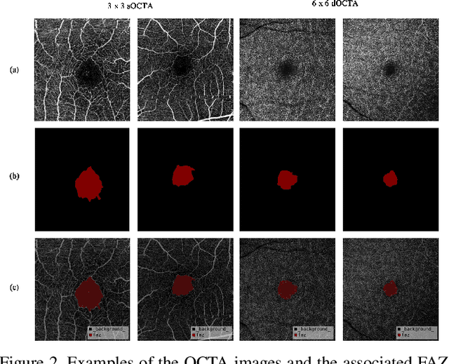 Figure 3 for A Deep Learning-based Quality Assessment and Segmentation System with a Large-scale Benchmark Dataset for Optical Coherence Tomographic Angiography Image