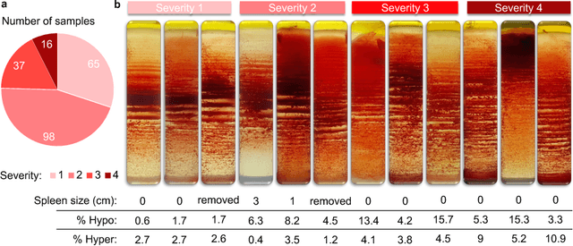 Figure 3 for Sickle Cell Disease Severity Prediction from Percoll Gradient Images using Graph Convolutional Networks