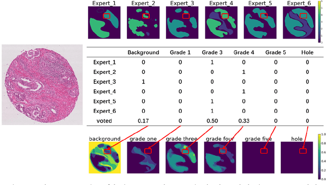 Figure 3 for Gleason Score Prediction using Deep Learning in Tissue Microarray Image