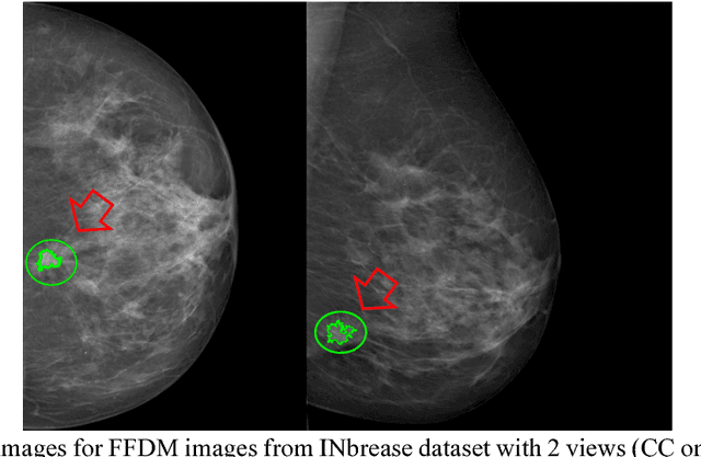 Figure 3 for SD-CNN: a Shallow-Deep CNN for Improved Breast Cancer Diagnosis