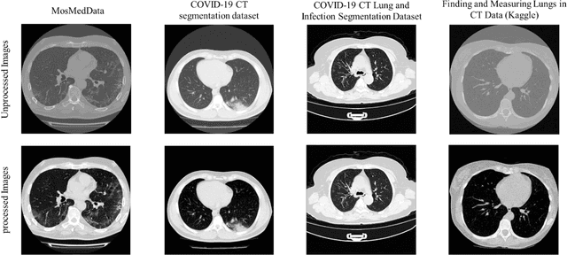 Figure 4 for Detection and severity classification of COVID-19 in CT images using deep learning