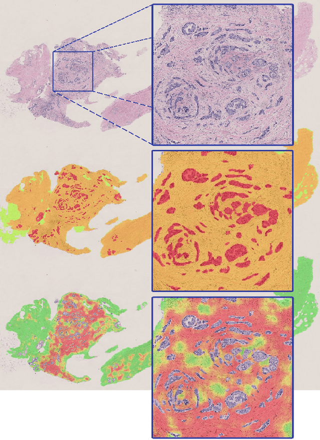 Figure 1 for Deep learning-based assessment of tumor-associated stroma for diagnosing breast cancer in histopathology images