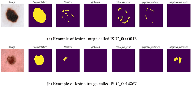 Figure 1 for Segmentation of skin lesions and their attributes using Generative Adversarial Networks
