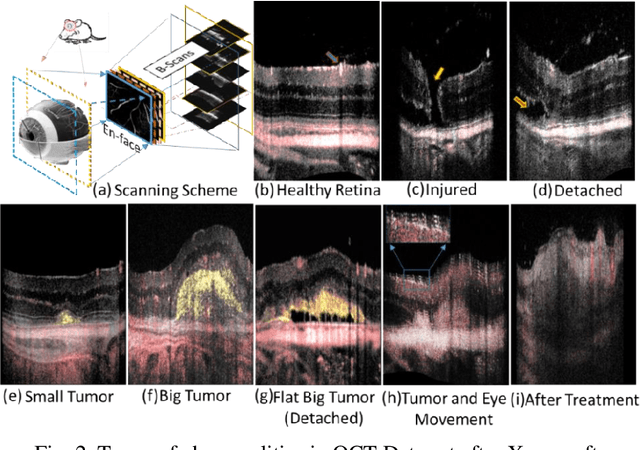 Figure 2 for Deep Learning models for benign and malign Ocular Tumor Growth Estimation