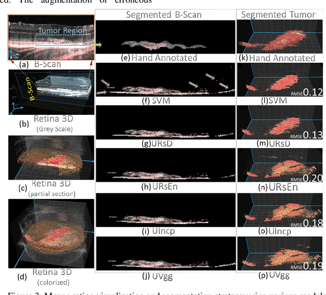 Figure 4 for Deep Learning models for benign and malign Ocular Tumor Growth Estimation