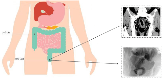 Figure 1 for Attention Augmented ConvNeXt UNet For Rectal Tumour Segmentation