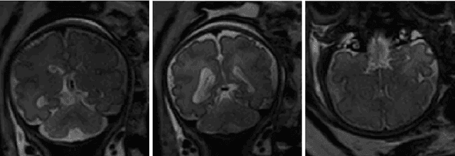 Figure 1 for Automatic brain tissue segmentation in fetal MRI using convolutional neural networks