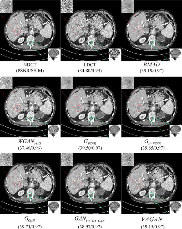 Figure 2 for Visual Attention Network for Low Dose CT