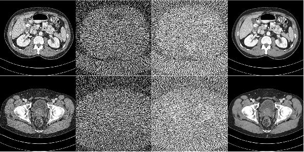 Figure 4 for Visual Attention Network for Low Dose CT