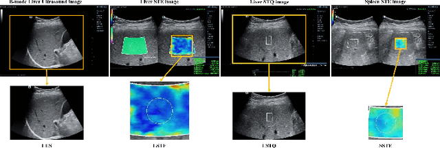 Figure 3 for Multi-Modal Active Learning for Automatic Liver Fibrosis Diagnosis based on Ultrasound Shear Wave Elastography