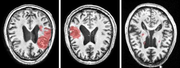 Figure 1 for Site Generalization: Stroke Lesion Segmentation on Magnetic Resonance Images from Unseen Sites