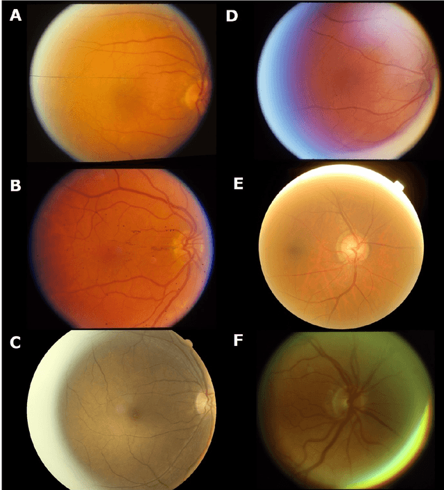Figure 3 for A multi-center prospective evaluation of THEIA to detect diabetic retinopathy (DR) and diabetic macular edema (DME) in the New Zealand screening program