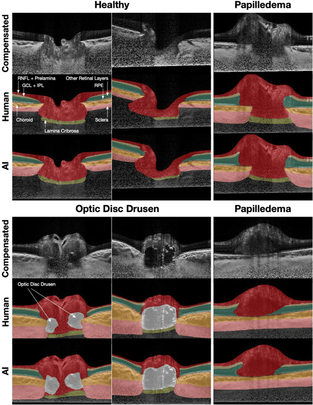 Figure 4 for 3D Structural Analysis of the Optic Nerve Head to Robustly Discriminate Between Papilledema and Optic Disc Drusen