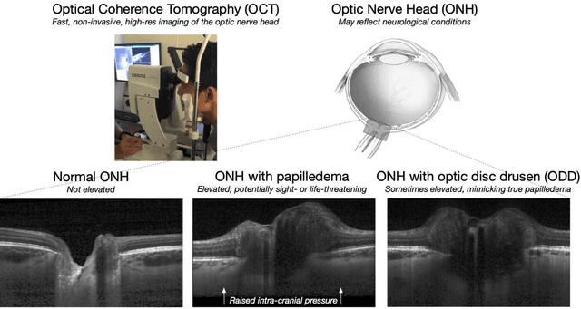 Figure 1 for 3D Structural Analysis of the Optic Nerve Head to Robustly Discriminate Between Papilledema and Optic Disc Drusen