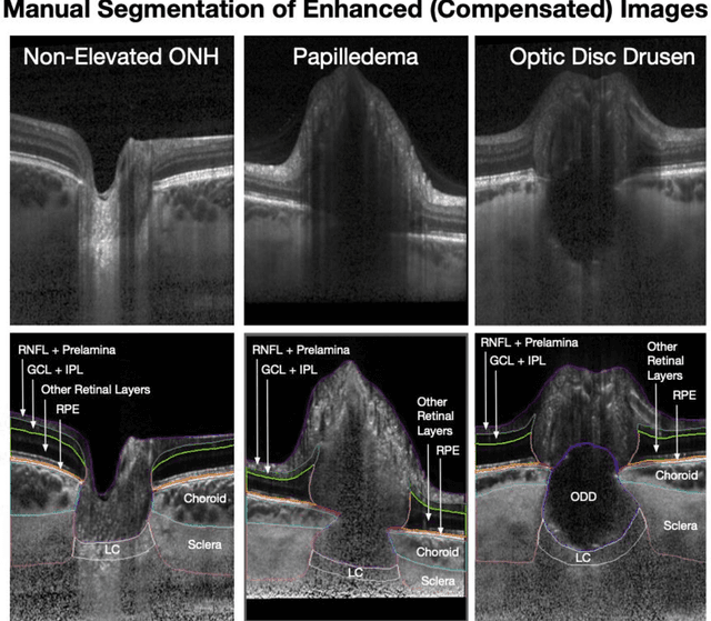 Figure 3 for 3D Structural Analysis of the Optic Nerve Head to Robustly Discriminate Between Papilledema and Optic Disc Drusen