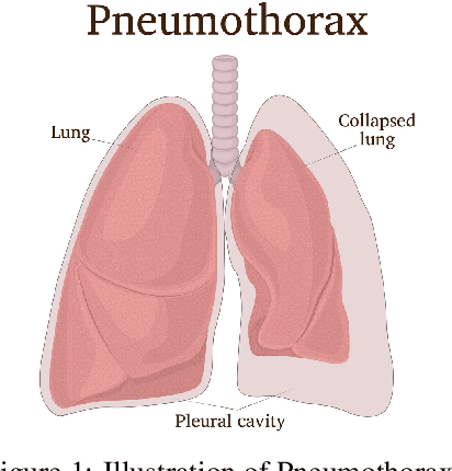 Figure 1 for The 2ST-UNet for Pneumothorax Segmentation in Chest X-Rays using ResNet34 as a Backbone for U-Net
