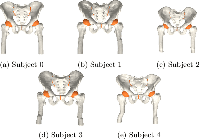 Figure 3 for A direct geometry processing cartilage generation method using segmented bone models from datasets with poor cartilage visibility