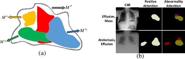 Figure 4 for Learning Hierarchical Attention for Weakly-supervised Chest X-Ray Abnormality Localization and Diagnosis
