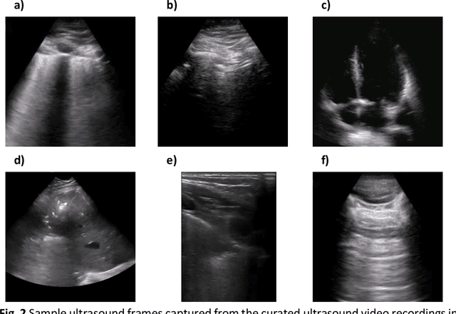 Figure 3 for COVIDx-US -- An open-access benchmark dataset of ultrasound imaging data for AI-driven COVID-19 analytics