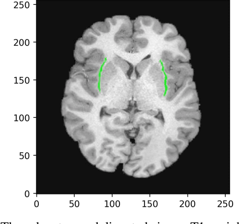 Figure 1 for Automated Human Claustrum Segmentation using Deep Learning Technologies