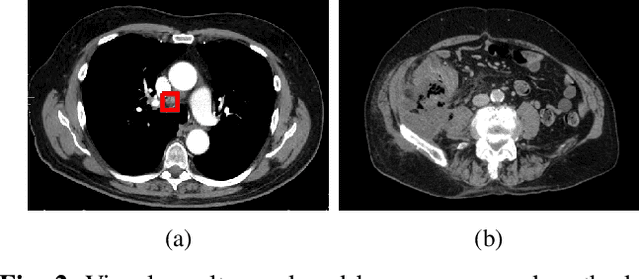 Figure 2 for Semi-supervised Multi-domain Multi-task Training for Metastatic Colon Lymph Node Diagnosis From Abdominal CT