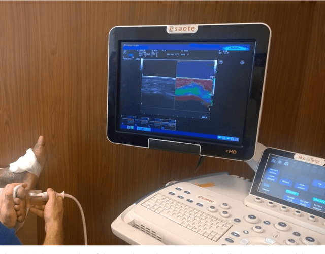 Figure 2 for A quantitative comparison of plantar soft tissue strainability distribution and homogeneity between ulcerated and non-ulcerated patients using strain elastography