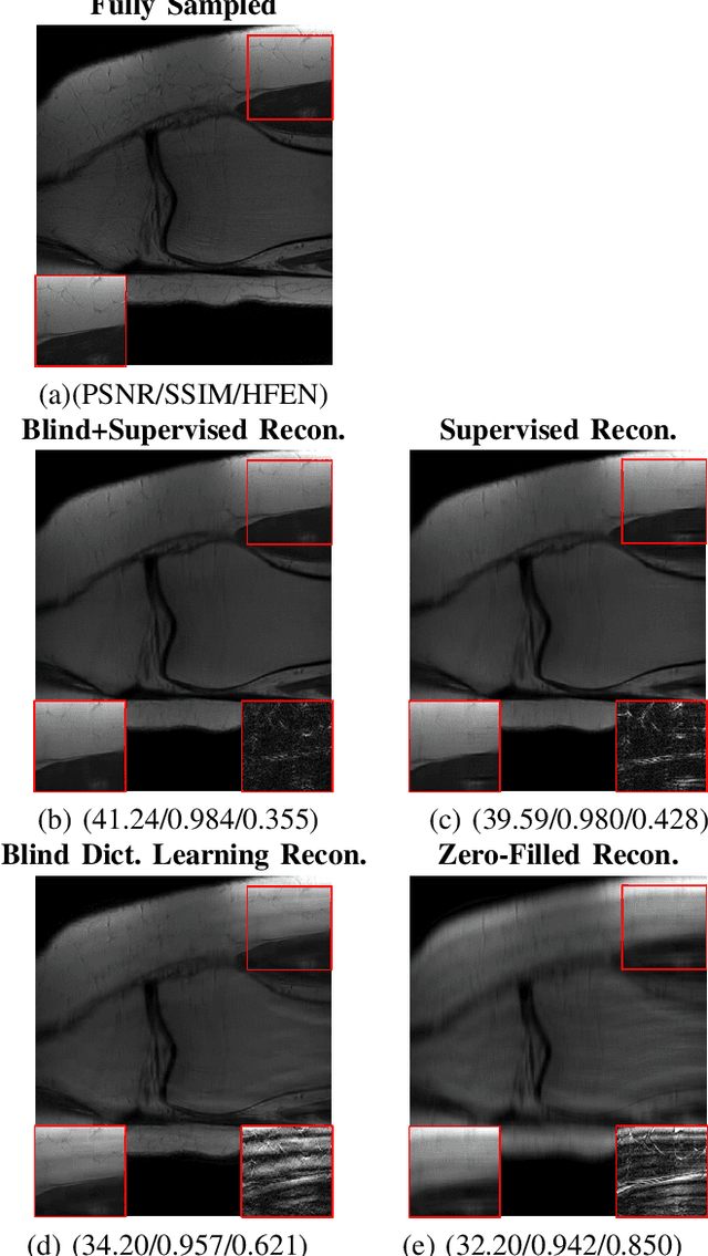Figure 4 for Blind Primed Supervised  Learning for MR Image Reconstruction