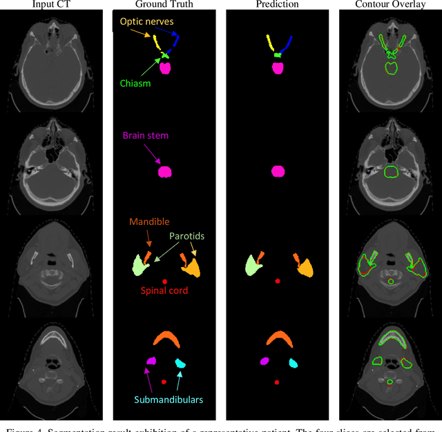 Figure 3 for Weaving Attention U-net: A Novel Hybrid CNN and Attention-based Method for Organs-at-risk Segmentation in Head and Neck CT Images