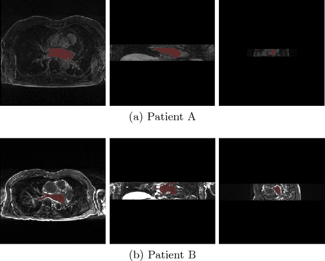 Figure 3 for Multi-Task Learning for Left Atrial Segmentation on GE-MRI